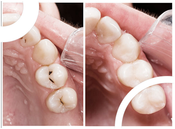 Image de LA POSE DE PROTHÈSES DENTAIRES