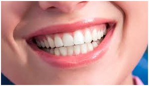 Image de LE REMODELAGE DU SOURIRE