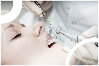 Image de Nettoyage régulier de la dentition