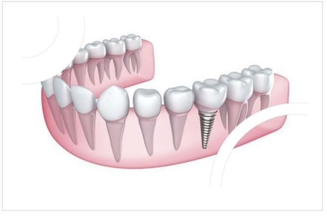 Image de IMPLANTS DENTAIRES